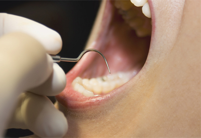 Dangers of Gum Disease Merced, CA
