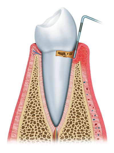Stages of Gum Disease Merced, CA